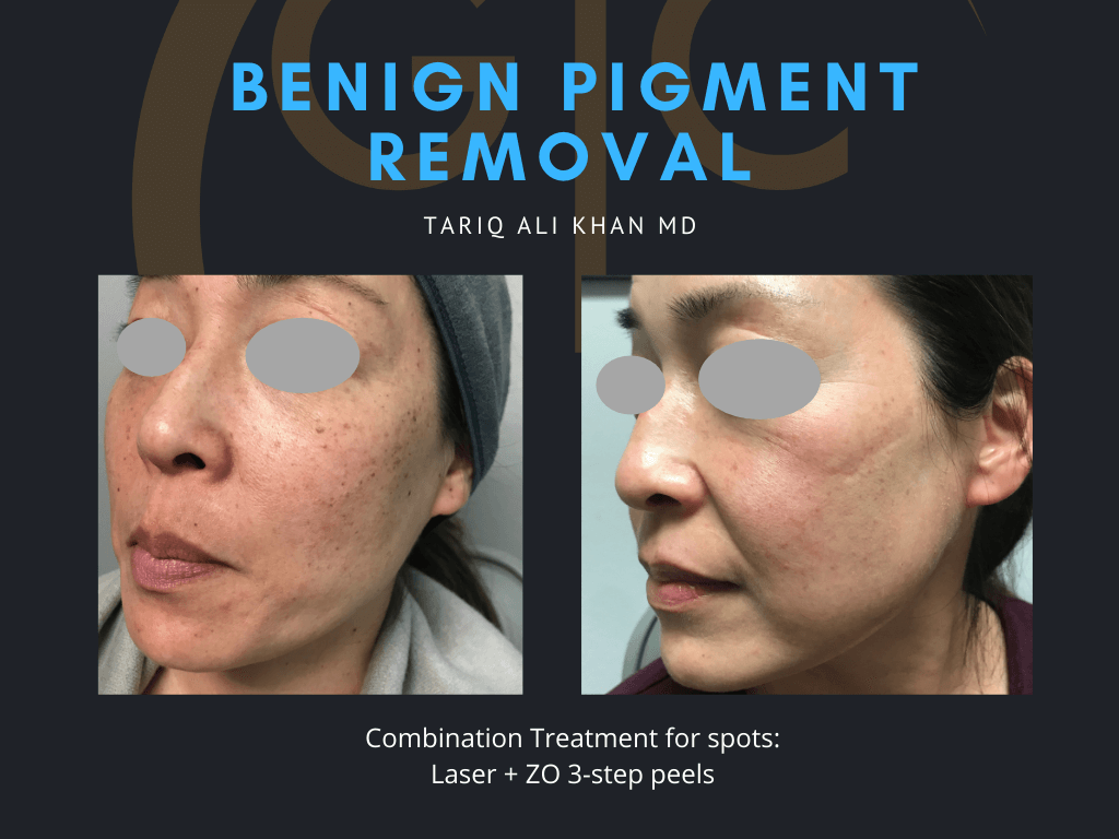 Gentle Care Laser Tustin Before and After picture - Mole Removal